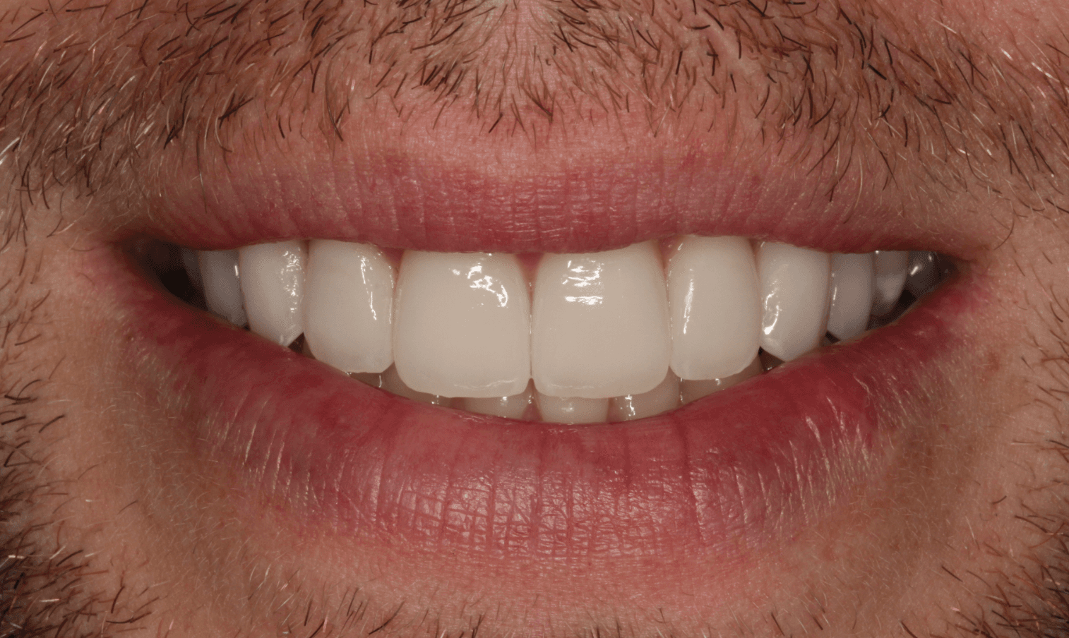 Custom Porcelain Veneers After Makeover