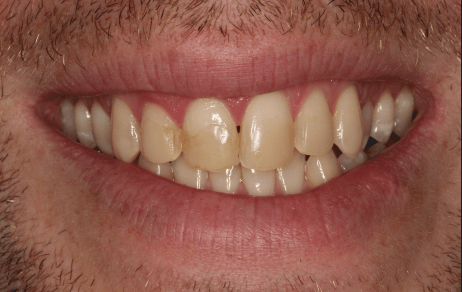 Teeth Before Porcelain Veneers Makeover